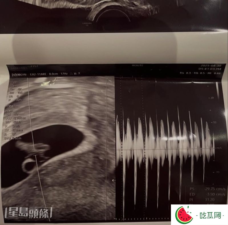 徐敏在于IG大曬胎兒超聲波照，宣布懷孕。