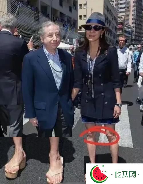 楊紫瓊腳趾頭外翻近照圖片，是什么原因造成的？